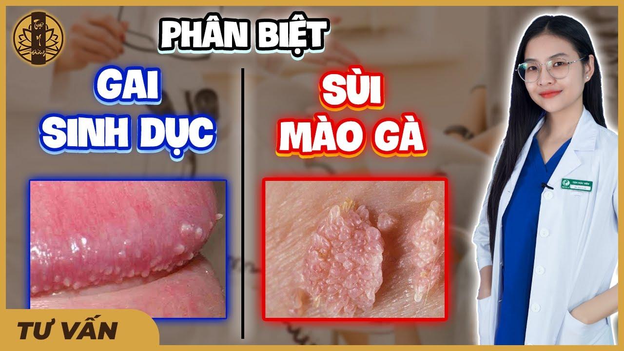 Gai sinh dục là gì? Gai sinh dụ nữ mọc ở đâu, dấu hiệu và cách chữa