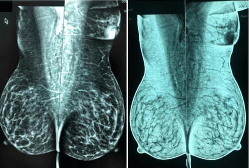 Tuyến vú phụ: Những điều cần biết