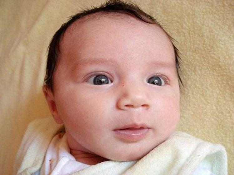 Bệnh lé (lác) mắt: Nguyên nhân, triệu chứng và cách điều trị