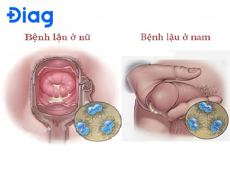 hình ảnh bệnh lậu
