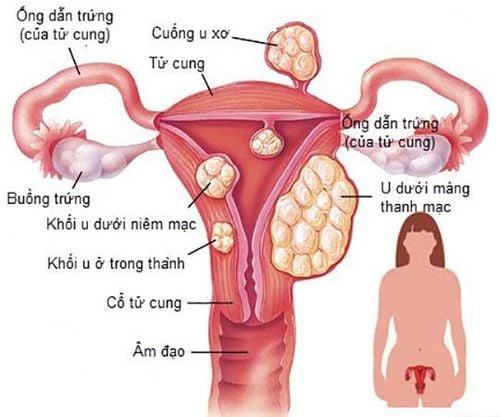 U xơ tử cung hoặc lipomas là ví dụ điển hình của khối u lành tính