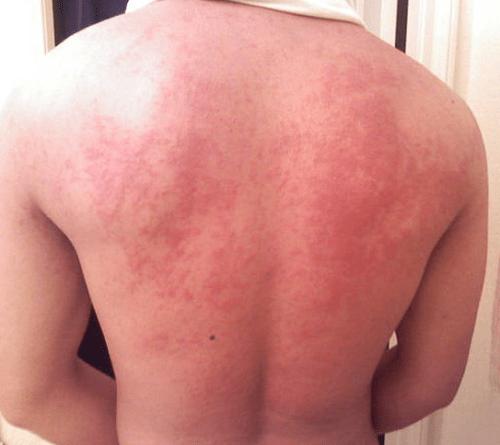 Biểu hiện của bệnh dị ứng lúa mì