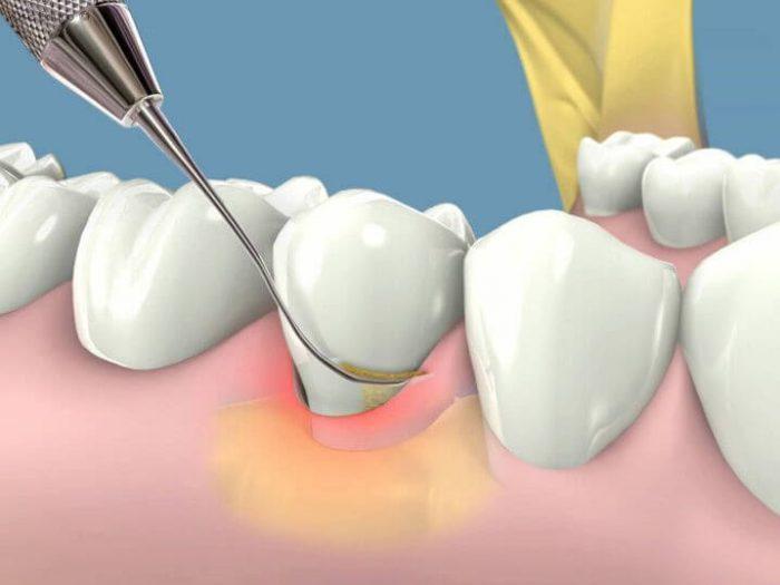 Lấy cao răng trong tiếng Anh là “Scaling/clean dental plaque”